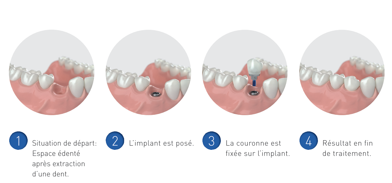 couronne sur implant