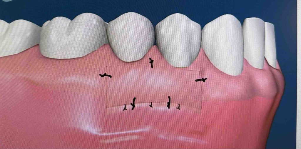 greffe gingivale placée sur le site receveur 
