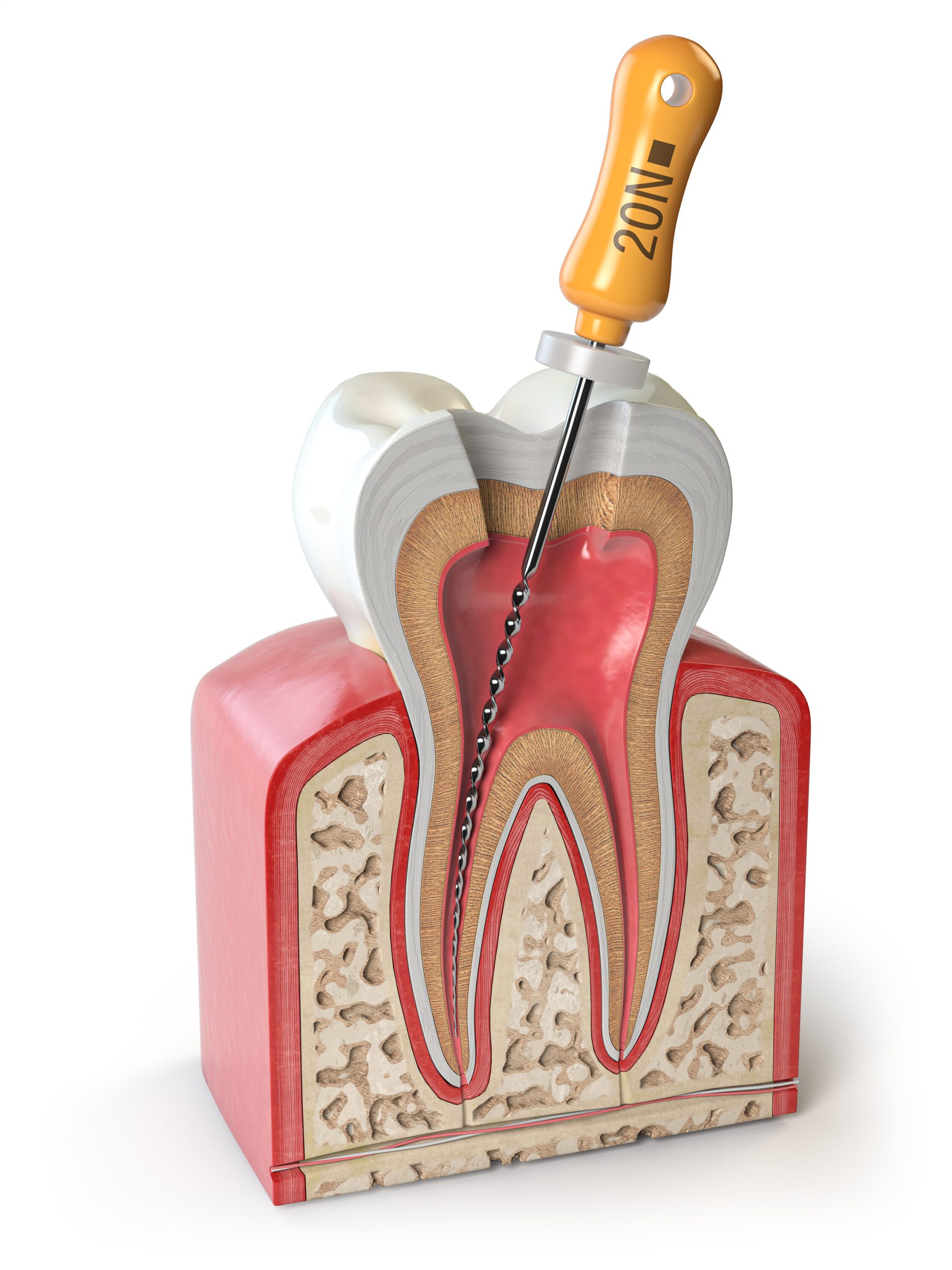 image montrant une gingivite et une parodontite